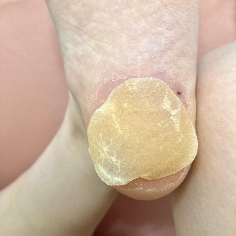 かかとの皮（♥の形）